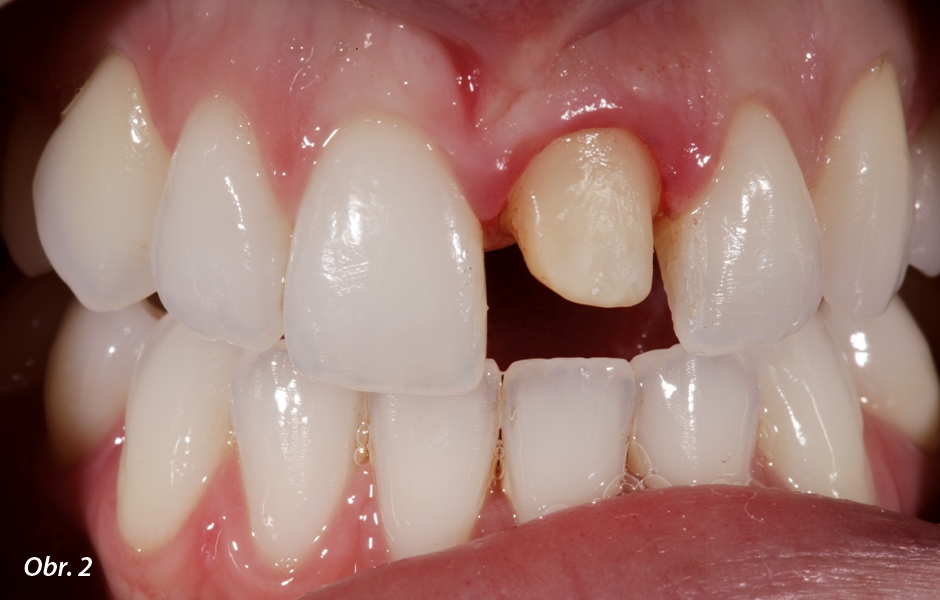 Relativně tmavý zub byl preparován s oblým schůdkem.