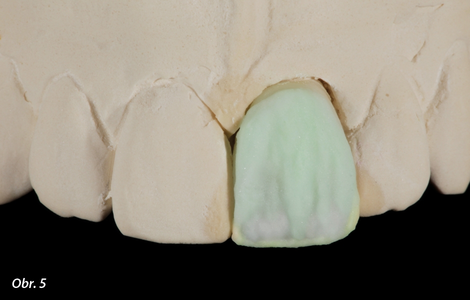 Univerzální řada materiálů IPS e.max Ceram umožňuje napodobit bělené odstíny zubů za přirozeně působícího odrazu světla.