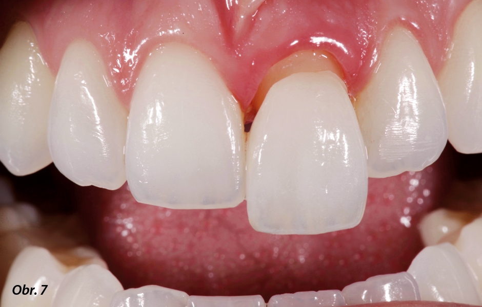Zkouška v ústech: navzdory přirozené translucenci náhrady korunka účinně zakryla barevně výraznou zubní strukturu.