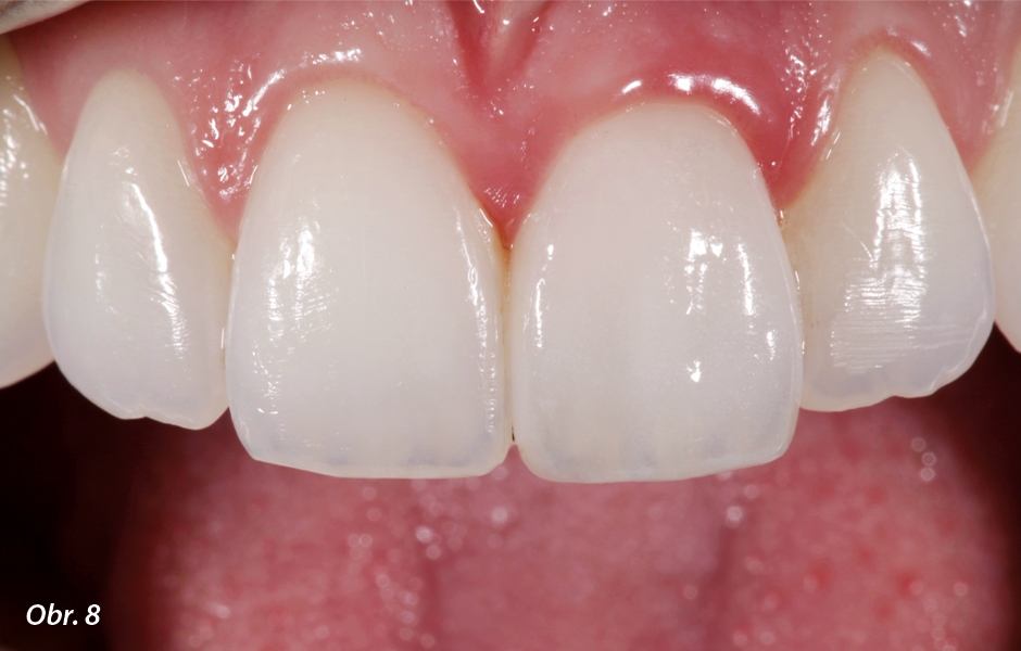 Zkouška v ústech: navzdory přirozené translucenci náhrady korunka účinně zakryla barevně výraznou zubní strukturu.