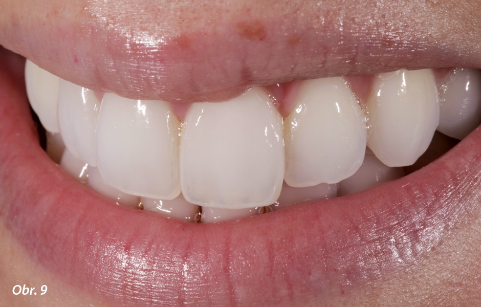Tvar a barva nové korunky na zubu 21 hladce splývá s okolím. 