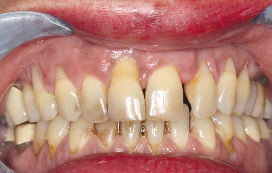 Klinická výchozí situace: Parodontálně poškozený chrup ve frontálním úseku s uvolněním a migrací zubů.