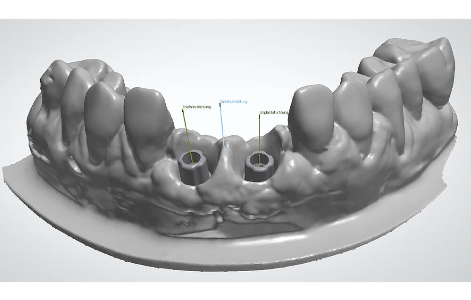 Digitalizovaný model pomocí platformy pro CAD/CAM výrobu Zeramex XT Zerabase X RB.