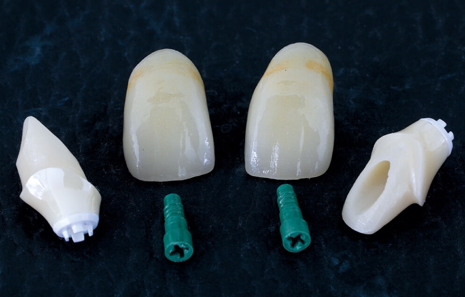 Definitivní abutmenty na adhezivní bázi (Zerabase X RB) s laboratorními šrouby (PEEK, Zeramex XT Try-in Screw) a korunkové náhrady zubů 11, 21 z IPS e.max Press LT.