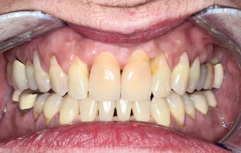 Výsledek 4 měsíce po nasazení korunkových náhrad zubů 11, 21 se zdravou měkkou periimplantátovou tkání bez podráždění.