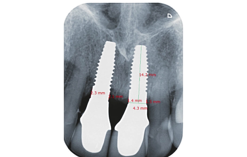 Standardizované snímky implantátových náhrad v oblasti zubů 11, 21 s naměřenými hodnotami krestální periimplantátové kosti po expozici implantátů, a dále po 6 měsících a po roce od definitivního protetického ošetření.