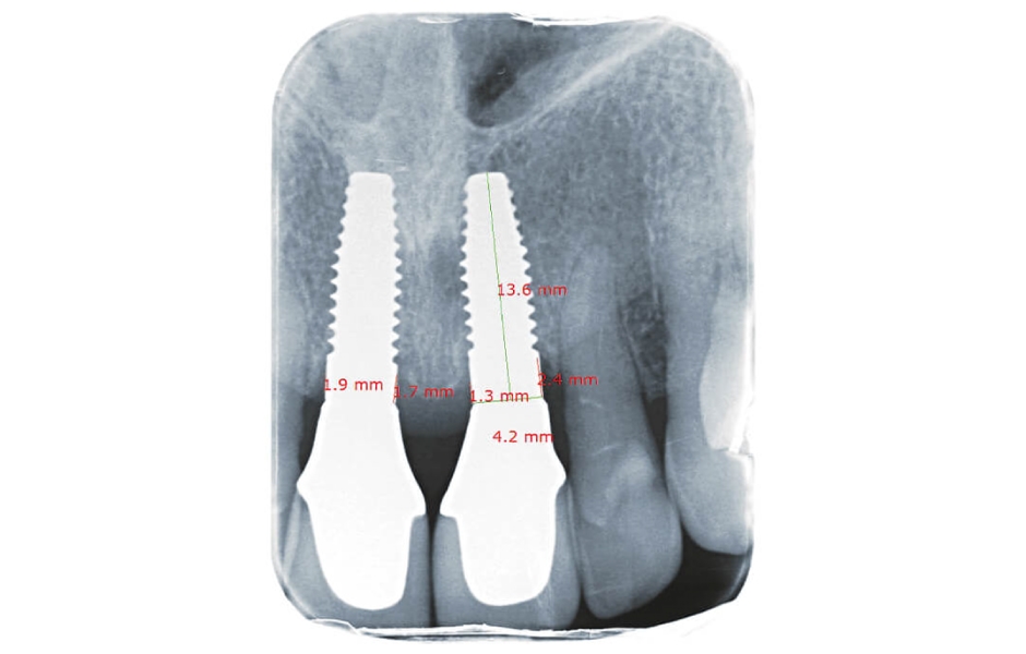 Standardizované snímky implantátových náhrad v oblasti zubů 11, 21 s naměřenými hodnotami krestální periimplantátové kosti po expozici implantátů, a dále po 6 měsících a po roce od definitivního protetického ošetření.