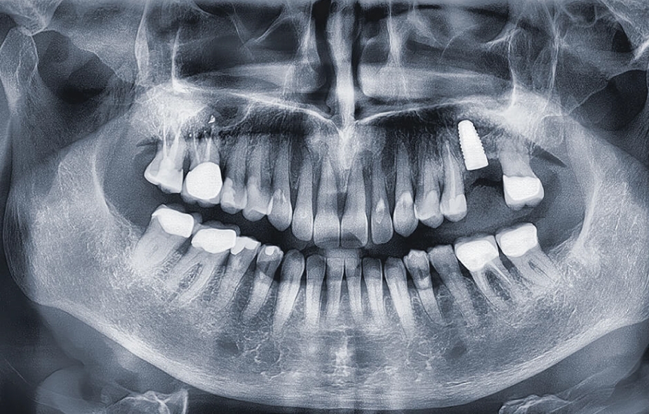 Rentgenologický nález s významnou kostní ztrátou a periradikulárními záněty v oblasti zubů 11, 21.