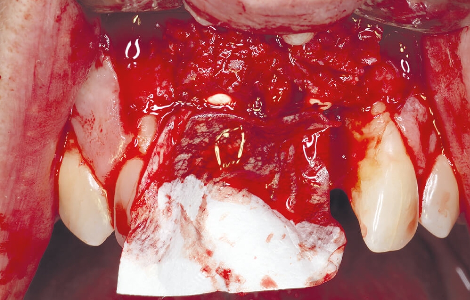 Augmentace vestibulární kosti v oblasti zubů 11, 21 s membránou Jason (Botiss/Straumann).