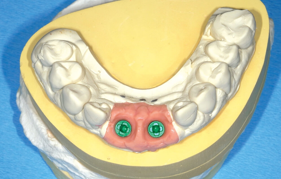 Hlavní pracovní model s gingivální maskou a laboratorním analogem implantátu Zeramex XT Digital Implant Replica RB.