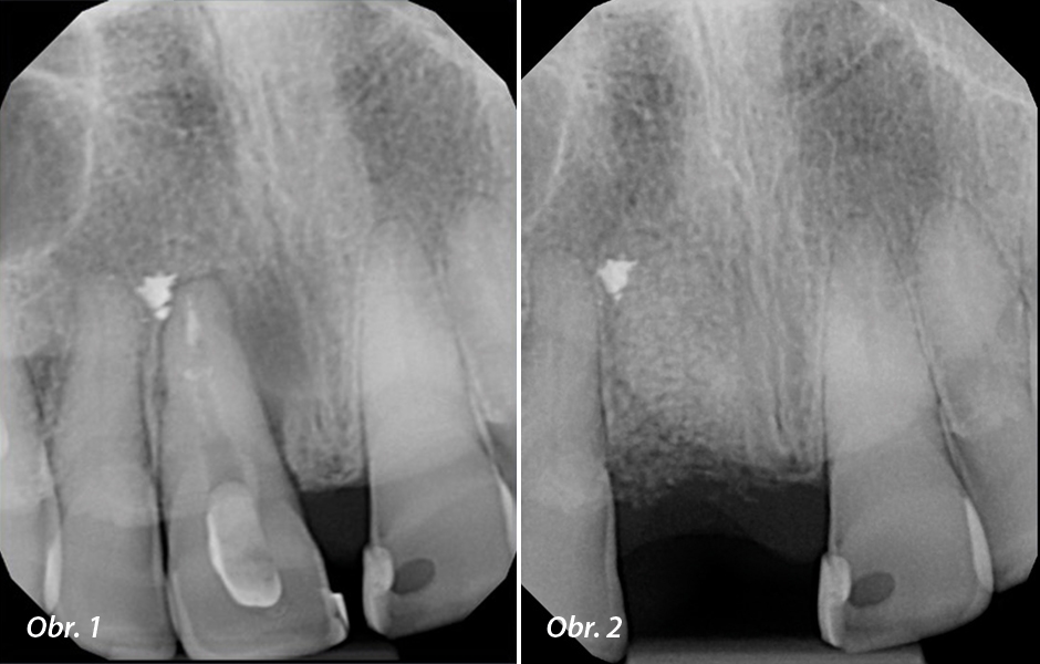 Obr. 1: Situace před ošetřením: Selhávající ošetření kořenového kanálku se špatnou prognózou opětovného endodontické ošetření. Obr. 2: Po extrakci a 5měsíční době hojení s kortikospongiózním aloštěpem (Newport Surgical).