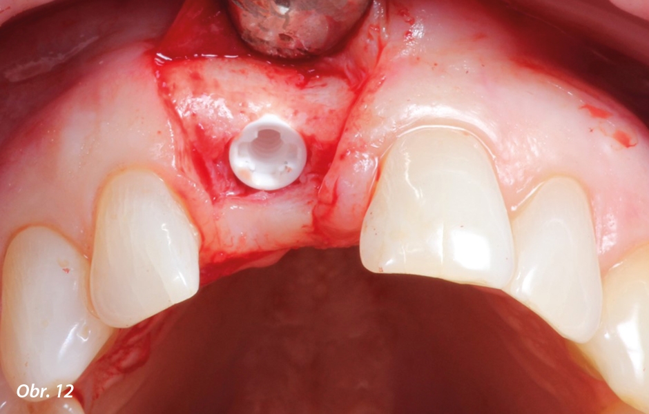 Okluzální pohled na konečné zavedení implantátu.