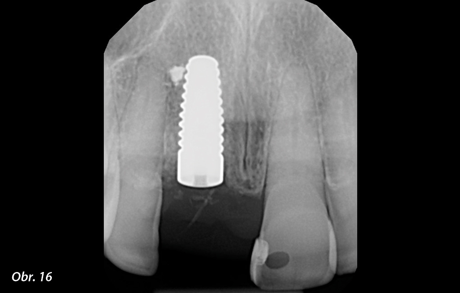 Sešití vstřebatelným vláknem (Newport Surgical).