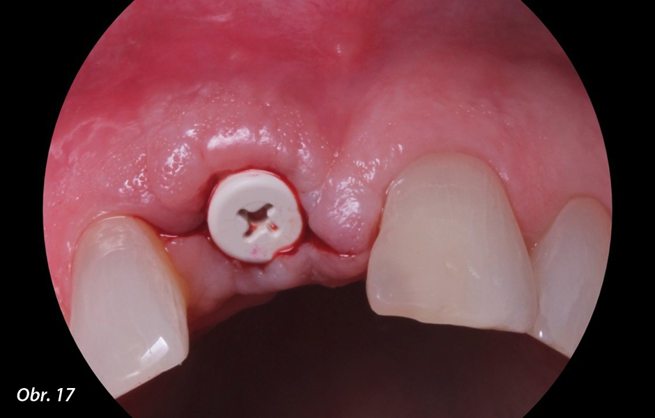Závěrečná RTG kontrola zavedení implantátu Zeramex 1,5 mm od sousedního zubu 12 a mimo oblast původního kořenového kanálku.