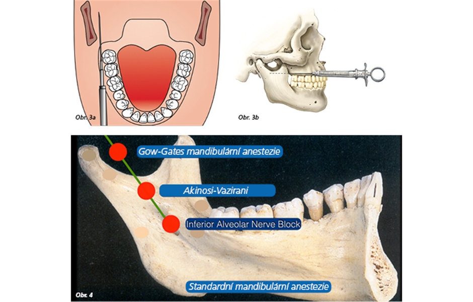 Obr. 3a, b: Blokáda n. alveolaris inferior při zavřených ústech technikou Akinosi-Vazirani  Obr. 4: Techniky mandibulární anestezie ilustrující koncept „výše je lépe“
