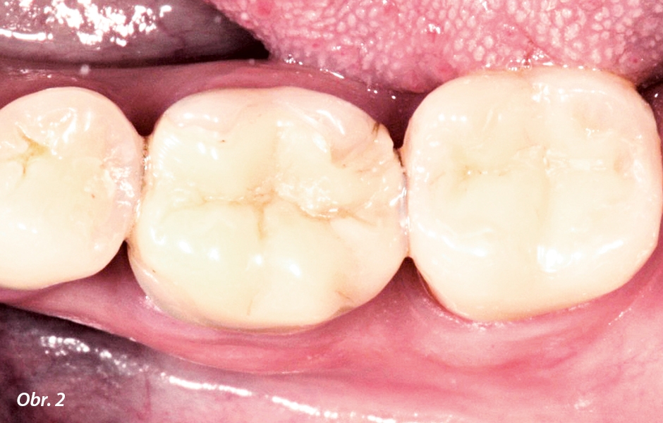 Vzhledem k velikosti výplně nemusí být množství zbývající zubní struktury dostatečné pro zajištění potřebné stability přímé kompozitní výplně