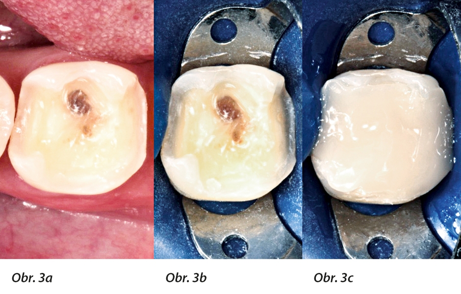 Po odstranění staré výplně je jasné, že pro zajištění potřebné stability rekonstrukce zubu je nutná korunka. Zub byl dostavěn pomocí bulk-fillového kompozitu a k adhezi byl použit 3M™ Single Bond™ Universal