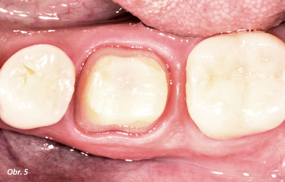 Jeden týden po provedení preparace je dosaženo zdravého stavu měkkých tkání, a tedy výchozího stavu pro vysoce kvalitní přesný otisk situace v ústech. 