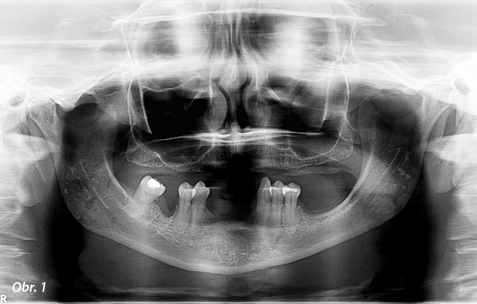 Předoperační OPG a intraorální pohled
