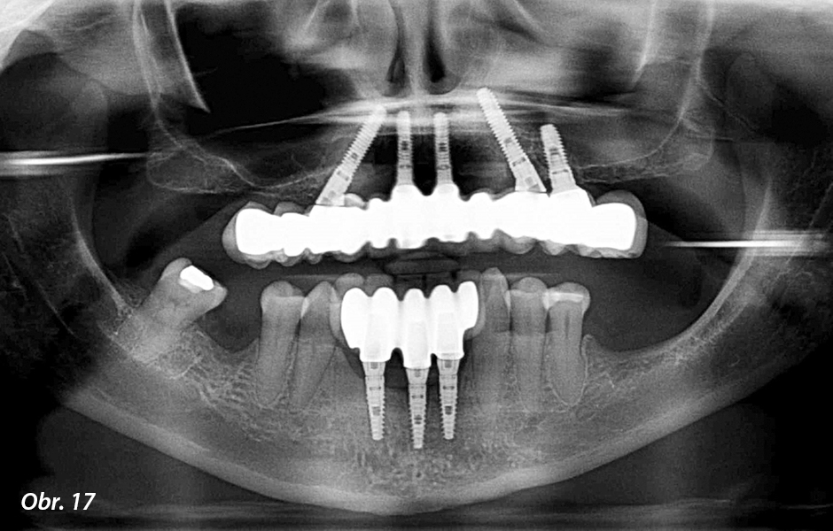 Finální metalokeramická náhrada šroubovaná na implantátech