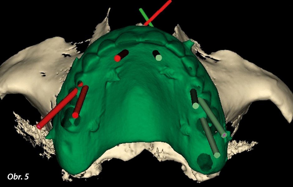 Překrytí naskenované náhrady a maxily k protetickému plánování umístění implantátů