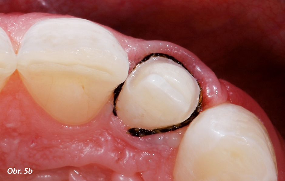 Stará výplň byla odstraněna a zub byl napreparován na keramickou fazetu