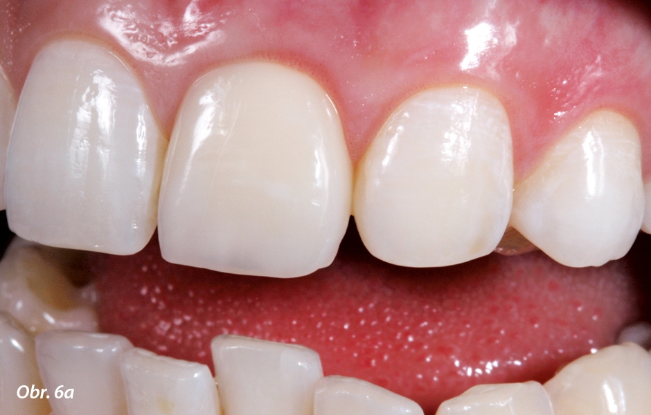 Uzávěr mezery. Stav po úspěšném uzávěru mezery mezializací zubu 23 pomocí ortodontického aparátu po traumatické ztrátě zubu 22. Zub 21 je opatřen laboratorně zhotoveným dlouhodobým provizoriem.