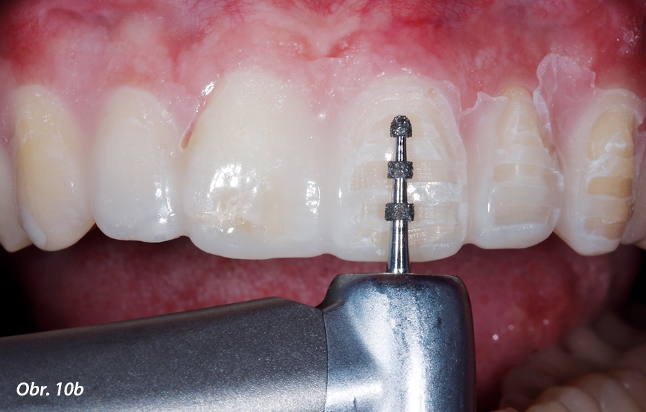 Broušení. Mock-up, aplikovaný pomocí diagnostické šablony, slouží jako vodicí linie během preparace zubů. Pomocí hloubkového drážkovače se provádí stanovení nezbytného množství tkání určeného k odbroušení. 