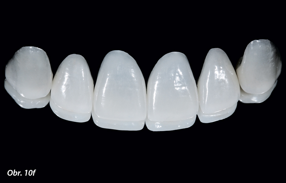 Fazety z vrstvené keramiky (zubní technik: Hubert Schenk, Mnichov)