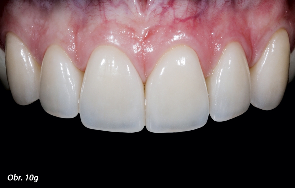Adhezivně fixovanými keramickými fazetami se podařilo významně zlepšit estetiku frontálních zubů. (Tento případ byl řešen ve spolupráci s Dr. Christinou Fotiadou, Mnichov)