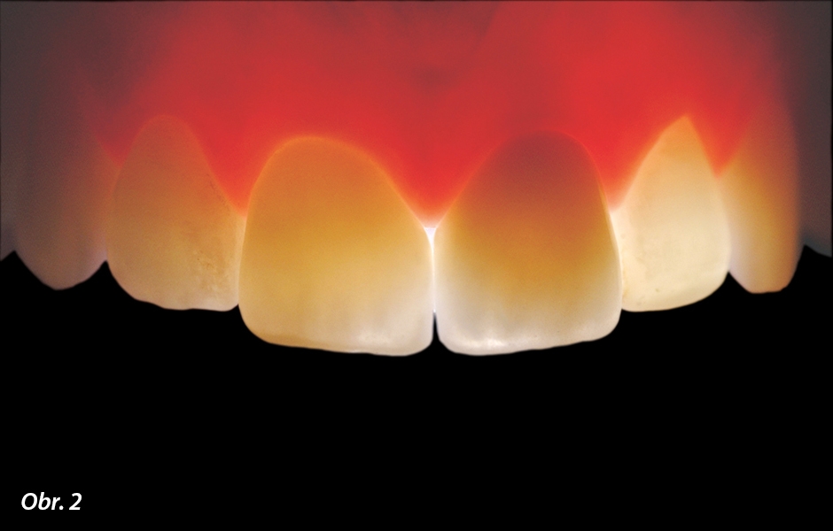 Snímek průchodu světla. Zub 11 je ošetřen keramickou fazetou a zub 21 keramickou korunkou. Dynamika světla u zubu 11 není přítomnou fazetou nijak negativně ovlivněna.