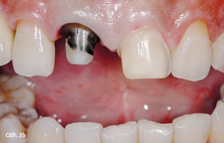 U zubu 11 byl pahýl po sejmutí staré korunky vyleštěn, zub 21 byl po odstranění staré kompozitní výplně napreparován na fazetu. Je jasně patrné rozdílné množství odbroušených tkání.