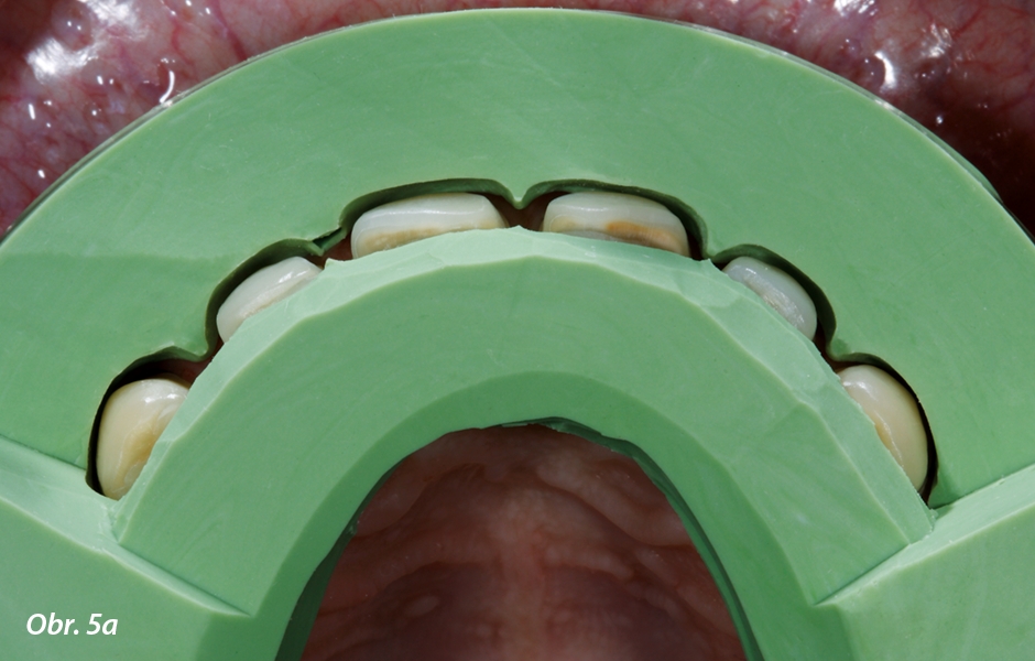 Silikonový klíč. Kontrola labiální a aproximální redukce tvrdých zubních tkání pomocí silikonového klíče zhotoveného podle waxupu (horizontálně rozříznutá preparační šablona) (a).