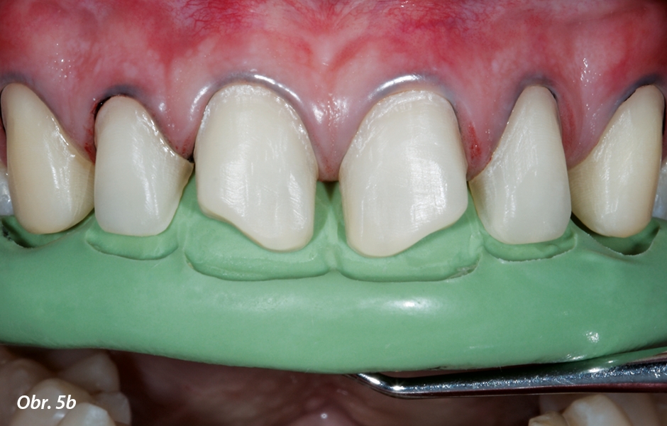 Kontrola incizální redukce tvrdých zubních tkání pomocí silikonového klíče zhotoveného podle wax-upu (b).