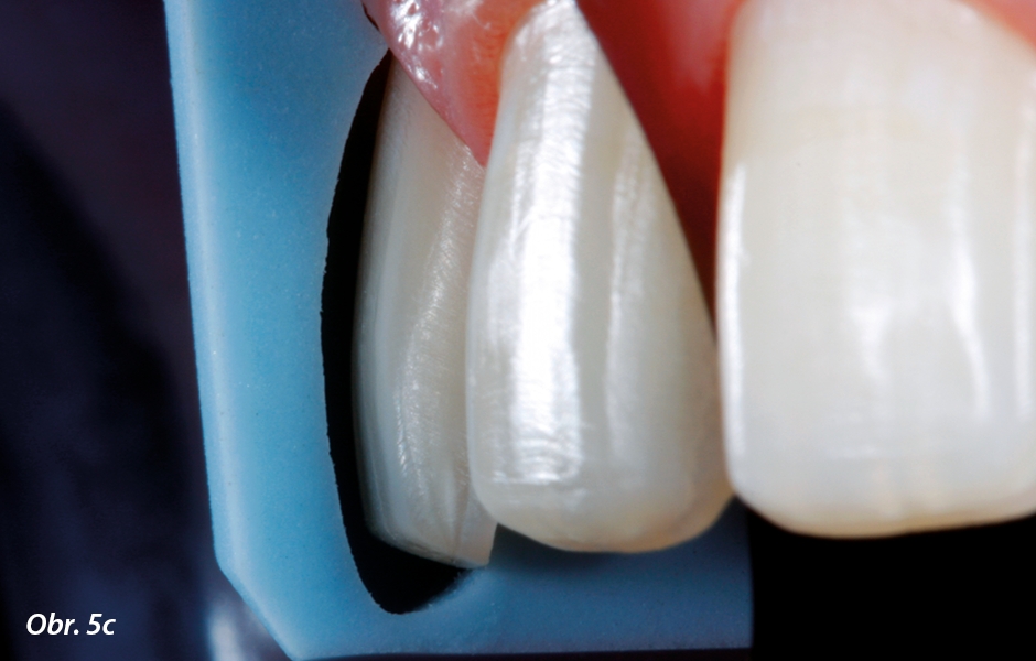 Kontrola labiální a aproximální redukce tvrdých zubních tkání pomocí silikonového klíče zhotoveného podle wax-upu (vertikálně rozříznutá preparační šablona) (c).