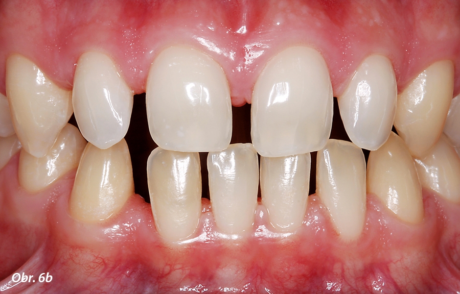 Postavení nekariézních zubů se perfektně hodí pro zhotovení fazet k uzavření mezer (b).