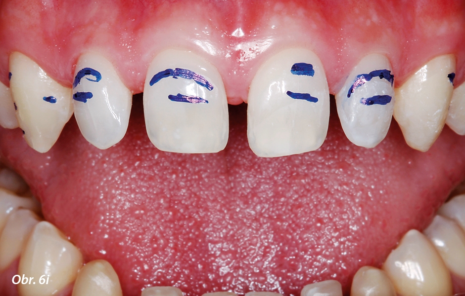 Po sejmutí mock-upu jsou patrná místa (vyznačená voděodolnou fixou), na kterých drážkovač pronikl pryskyřicí mock-upu až na zubní sklovinu (i).