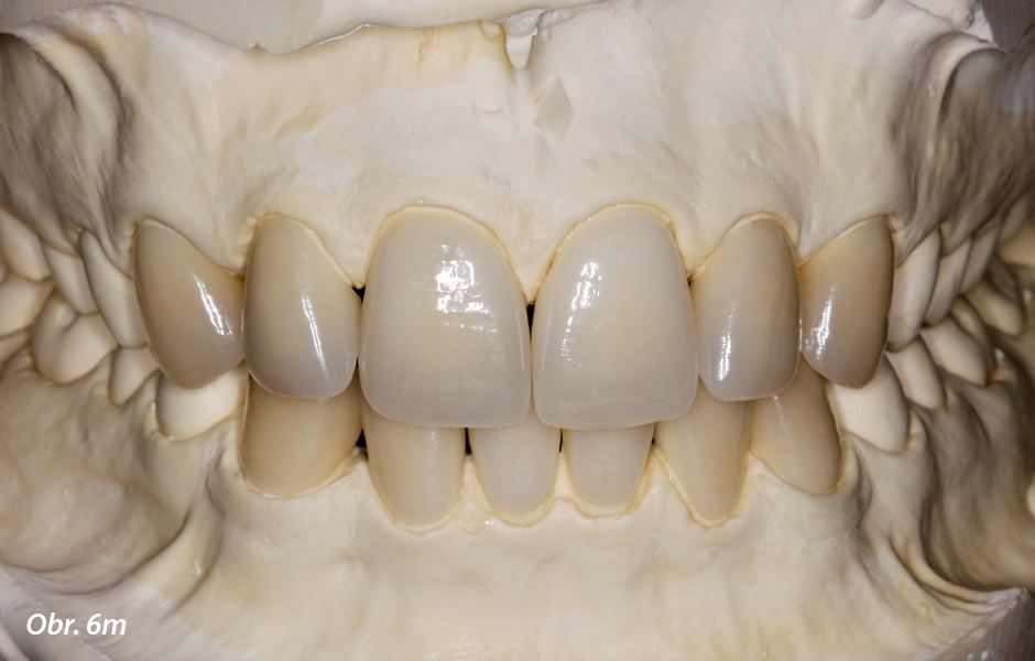 Fazety z vrstvené keramiky. Individuálně vrstvené fazety a nedělený sádrový model (zubní technik: Hubert Schenk, Mnichov, Německo) (m).