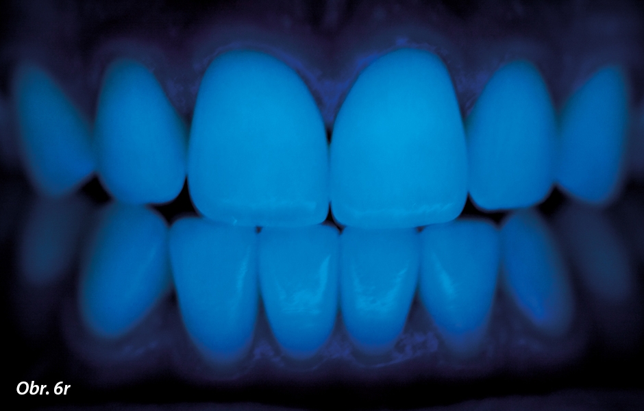 Závěrečná situace. Při ultrafi alovém světle jsou vidět fl uoreskující vlastnosti keramických fazet podobné vlastním zubům.