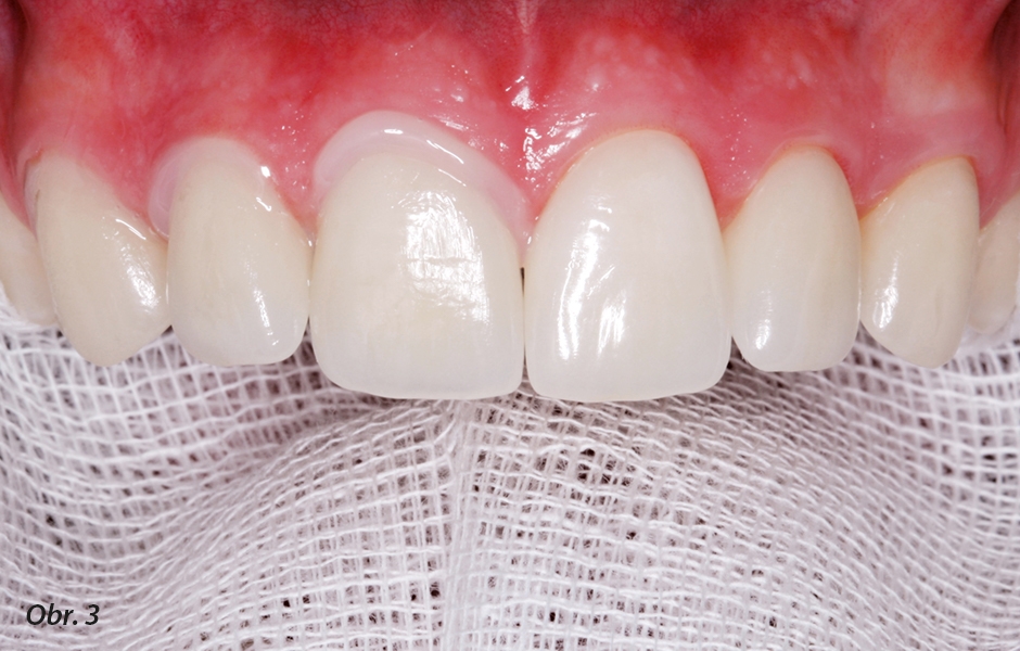  Zkouška estetiky fazet: fazety na zubech 13–11 nalepené na tvrdé zubní tkáně pomocí pasty Try-in (obarvený glycerinový gel), jejíž zabarvení koresponduje s příslušným fixačním kompozitem.
