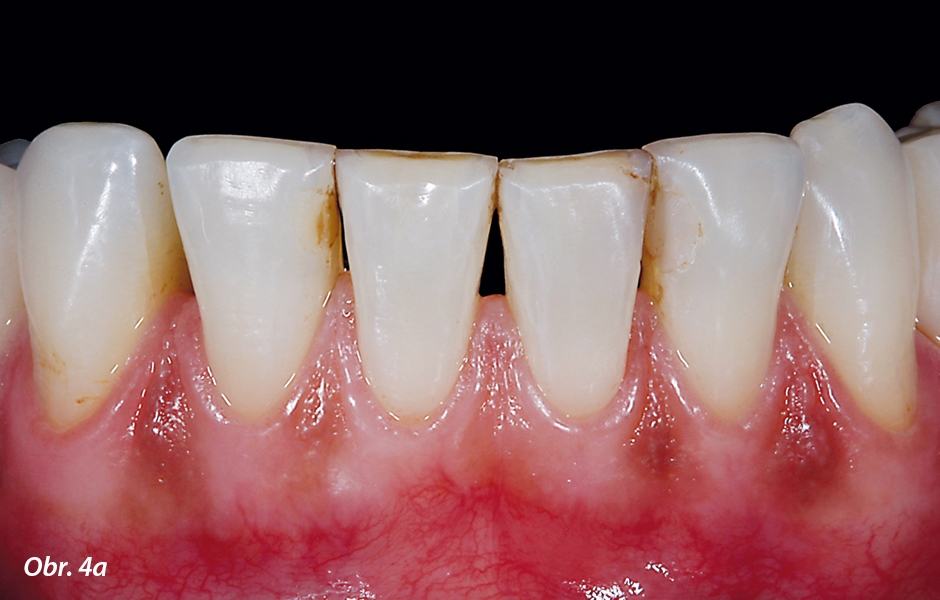 Výchozí situace: frontální zuby dolní čelisti s černými dírami mezi jednotlivými zuby a kompletně otevřeným aproximálním prostorem mezi zuby 42 a 44.