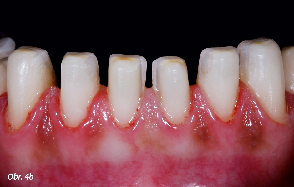 Preparace: zuby jsou napreparovány pro otisk ke zhotovení fazet. Aby bylo možno uzavřít černé díry mezi zuby, musí se aproximální prostory otevřít více orálně.  