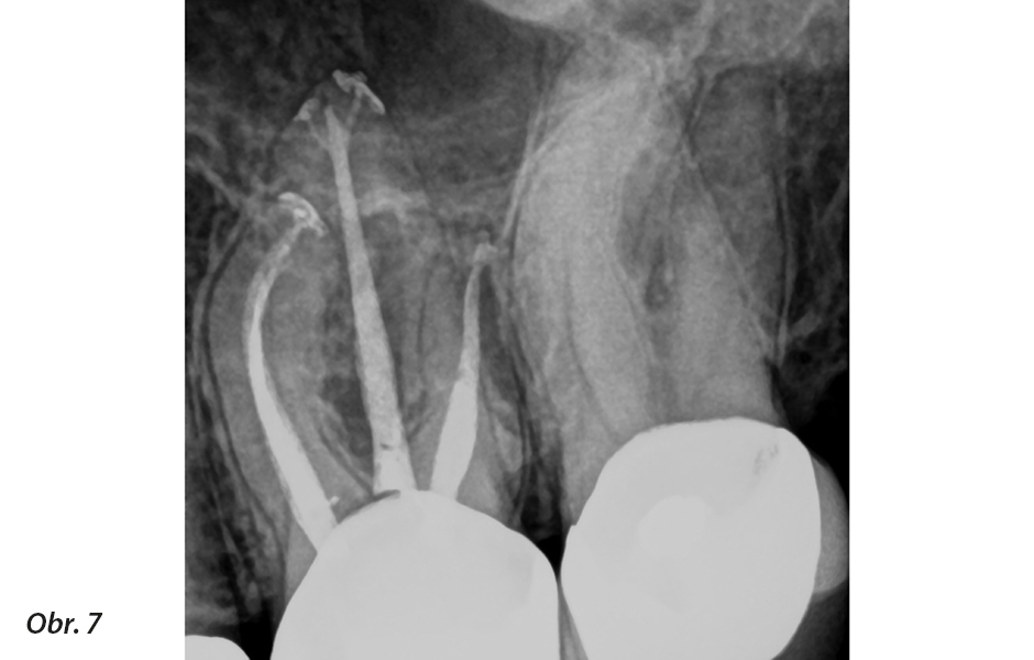 Pooperační rentgen po ošetření kořenových kanálků horního levého prvního moláru, kde byla provedena preparace kořenového kanálku jediným nástrojem WaveOne Gold Primary (Dentsply Sirona)