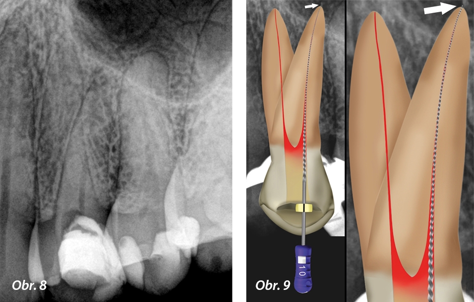 Obr. 8: Předoperační periapikální rentgenový snímek avitálního horního prvního premoláru s kazem pod dříve zhotovenou kompozitní výplní Obr. 9: Bukální kořenový kanálek zprůchodněný (šipka) s nástrojem K-File velikosti 10