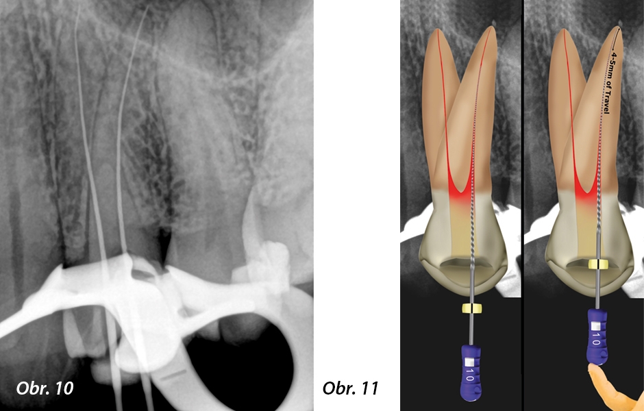 Obr. 10: Periapikální rentgenový snímek zobrazující polohu nástrojů během stanovení pracovní délky – dvakrát K-File o velikosti 10 v bukálním a palatinálním kořenovém kanálku, Obr. 11: Klinické potvrzení reprodukovatelné glide path: „Supervolný” K-File 10