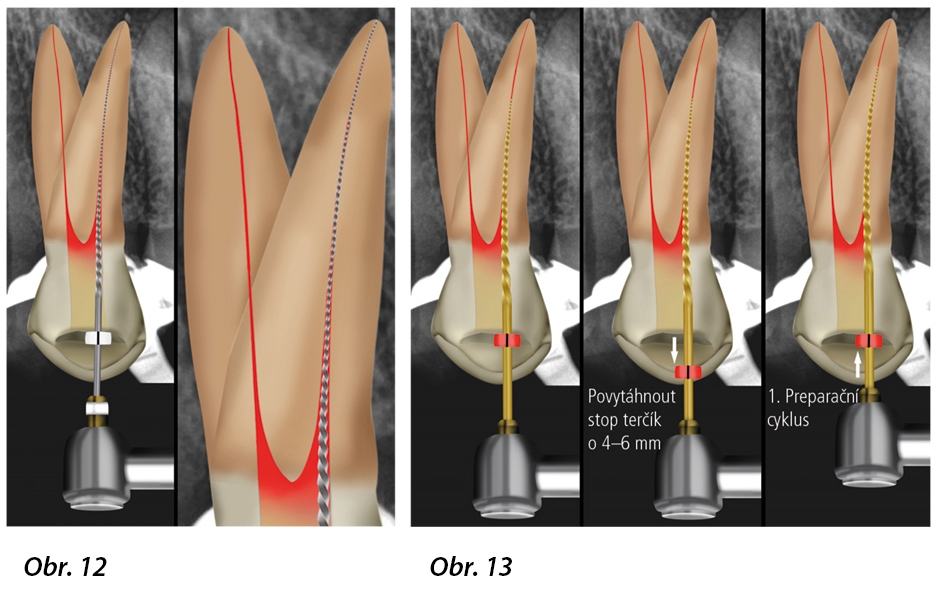 Obr. 12: Nástroj Proglider (Dentsply Sirona) je použit pro rozšíření reprodukovatelné mikro glide path