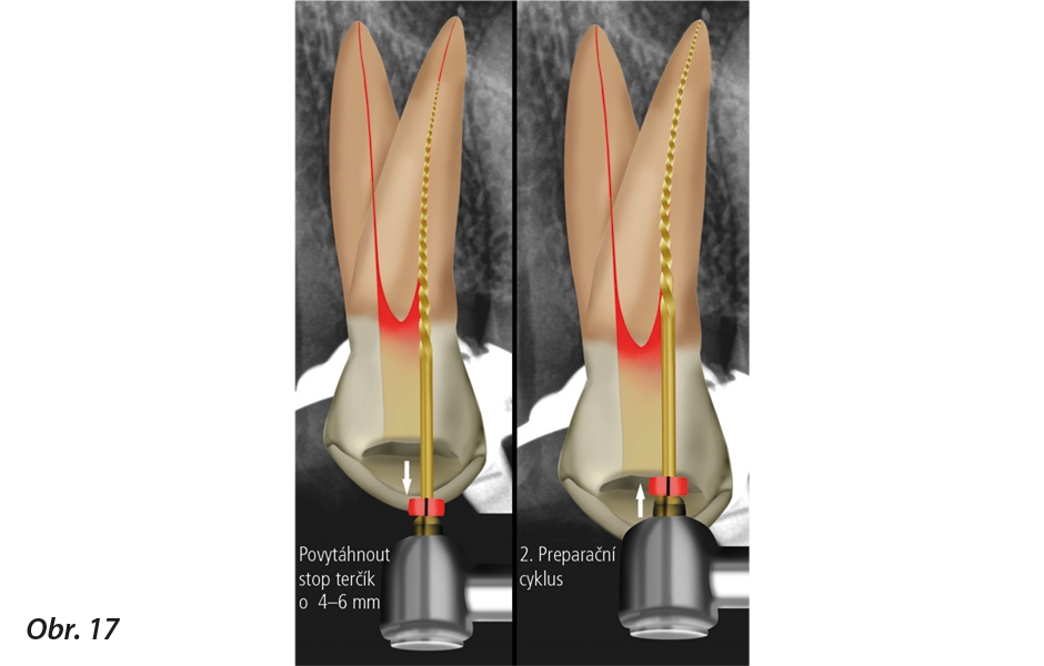 Obr. 17: a) Stop terčík se znovu nastaví na délku o dalších 4 až 6 mm nebo až k bodu předem stanovené pracovní délky; b) nástroj je znovu aktivován a začneme vypracovávat kořenový kanálek, dokud stop terčík nedosáhne referenčního bodu