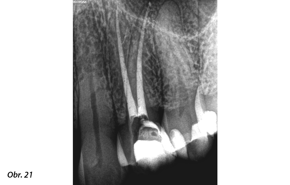 Výsledný fi nální rentgenový snímek po obturaci kořenových kanálků