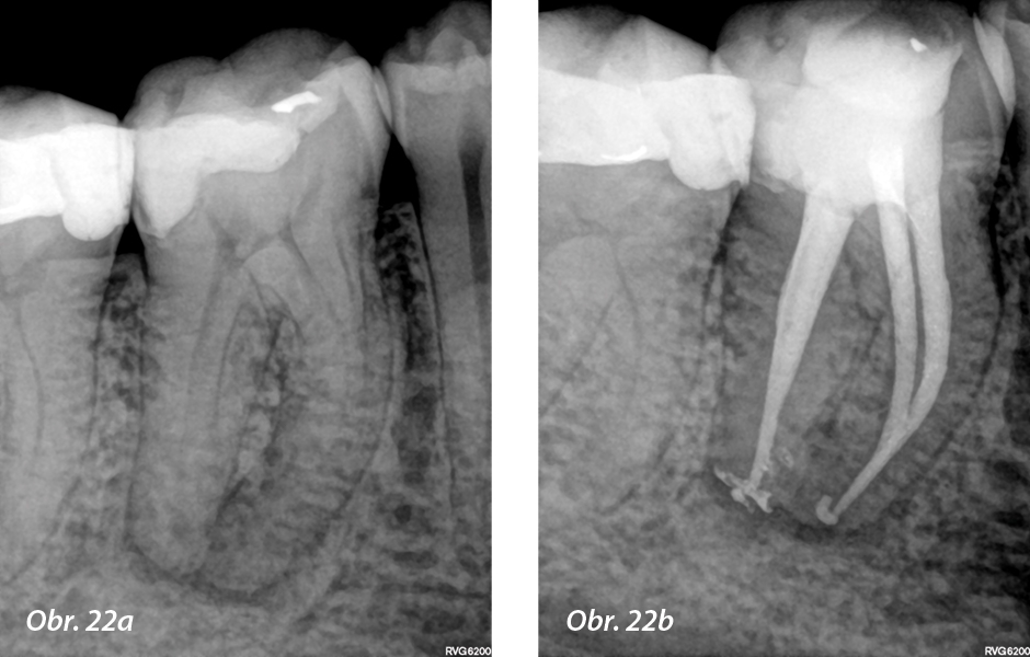 a) Preoperační periapikální rentgen; b) pooperační výsledek po preparaci kořenových kanálků, irigaci a zaplnění