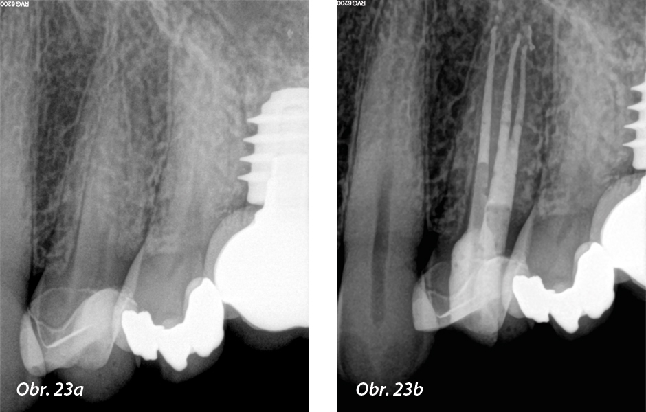 a) Preoperační periapikální rentgen; b) pooperační výsledek po preparaci kořenových kanálků, irigaci a zaplnění
